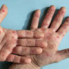 Monkeypox