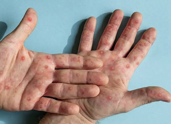 Monkeypox