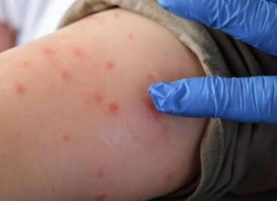 Mpox Cases